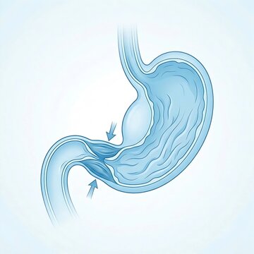 stomach illustrating pyloric stenosis.  pyloric sphincter is visibly narrowed and thickened, restricting the passage of food to the duodenum.  stenosis appears slightly enlarged due to retentio