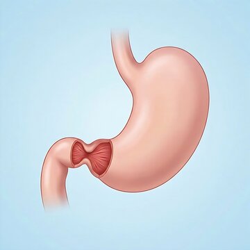 stomach illustrating pyloric stenosis.  pyloric sphincter is visibly narrowed and thickened, restricting the passage of food to the duodenum.  stenosis appears slightly enlarged due to retentio