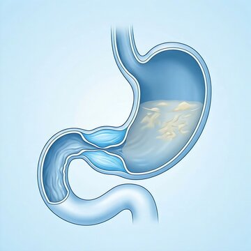 stomach illustrating pyloric stenosis.  pyloric sphincter is visibly narrowed and thickened, restricting the passage of food to the duodenum.  stenosis appears slightly enlarged due to retentio