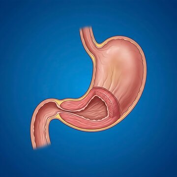 stomach illustrating pyloric stenosis. The pyloric sphincter is visibly narrowed and thickened, restricting the passage of food to the duodenum. The stomach body above the stenosis appears slightly en