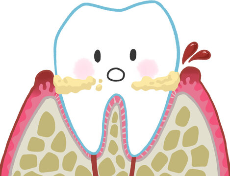 Gingivitis