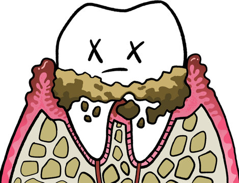 Periodontitis2