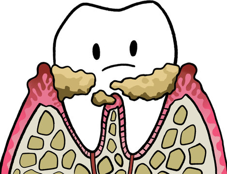 Periodontitis1
