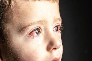 Fototapeta premium Child with Red Eyes and Viral Eye Infection