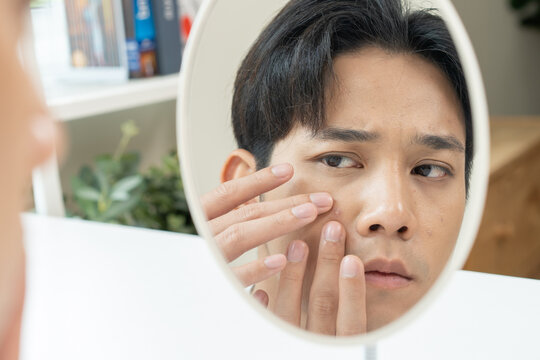 Asian men worry about acne on their faces when looking in the mirror