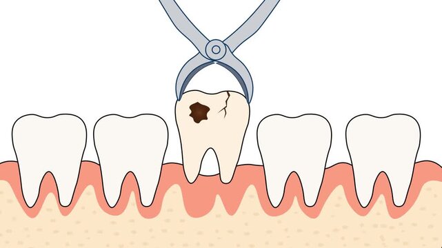 Decayed Tooth Extraction With Dental Forceps Flat Design Animation.  Removing  Operation of A Cracked Tooth From Healthy Gums, Illustrating Oral Surgery, Dentistry, And Dental Care 