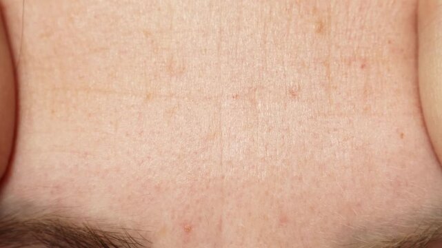 Female hands touching and squeezing her forehead wrinkles lines close up. Aging problems concept