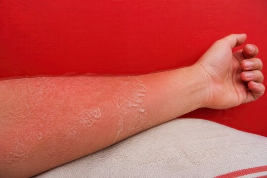 Sunburned forearm with peeling skin on red background