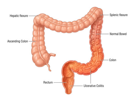 Human digestive system showing ulcerative colitis in colon isolated on white background