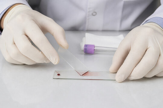 Laboratory Scientist Preparing Peripheral Blood Smear Slide