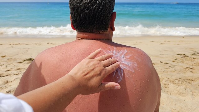 A person applies white sunscreen lotion in a sun shape to a sunburned back while sitting on warm sand at the ocean shore, conveying summer care, sun protection and vacation relaxation.