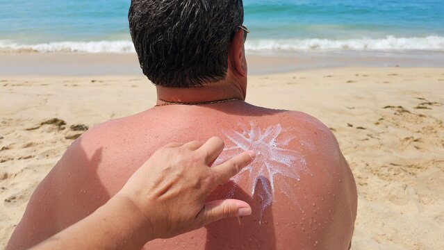 A person applies white sunscreen lotion in a sun shape to a sunburned back while sitting on warm sand at the ocean shore, conveying summer care, sun protection and vacation relaxation.