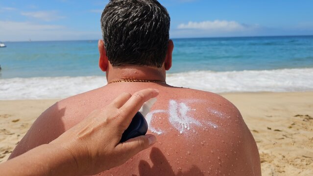 Hand applying sunscreen or after-sun lotion to a reddened sunburned back on a sandy beach, conveying sun protection, care, summer relaxation and travel safety under bright coastal sunlight.