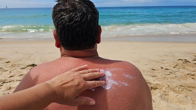 Man Having Sunscreen Applied to Sunburned Back on Sandy Beach During Summer Vacation.A hand spreads soothing sunscreen or aftersun lotion over a sunburned mans shoulder on a sandy beach, with waves in