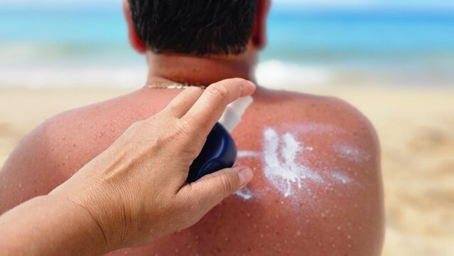 Hand applying sunscreen or after-sun lotion to a reddened sunburned back on a sandy beach, conveying sun protection, care, summer relaxation and travel safety under bright coastal sunlight.