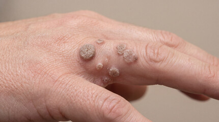 Fototapeta premium Warts on human hand skin close up showing viral skin condition medical dermatology