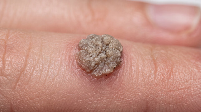 Wart on human finger close up showing skin lesion and human papillomavirus symptom in medical photography
