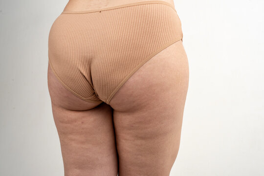 Cellulite on thigh with skin structure. Body shaping and weight loss for cellulite on thigh. Dermatological skincare for cellulite and thigh care. Real female body with cellulite on thigh.