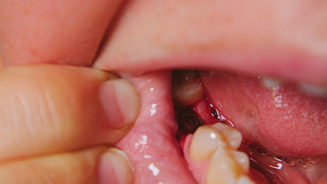 Closeup view of dental procedure with visible bleeding gums exposed tooth socket. Focus on oral cavity with fingers retracting tissue. Clinical lighting highlights red tissue moist surfaces