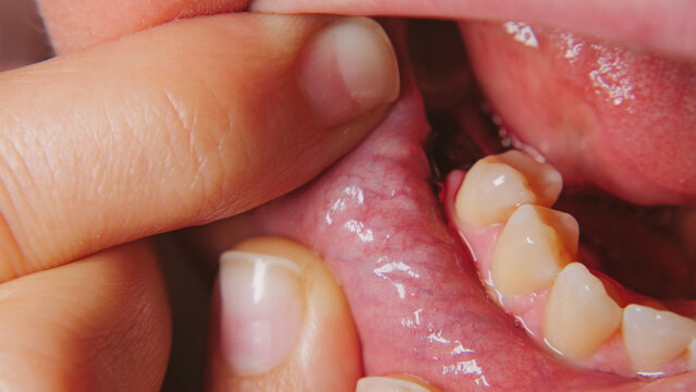 Extreme closeup of open human mouth revealing teeth pink gums. Finger pulls lip to expose dental structure. Clinical lighting highlights texture moisture