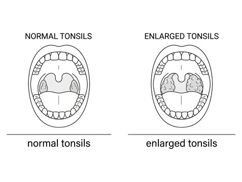 Tonsillitis comparison medical illustration showing normal vs enlarged tonsils