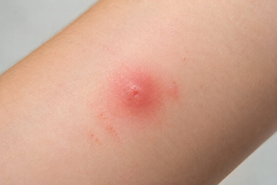 Red swollen mosquito bite on forearm skin, insect bite irritation and allergy
