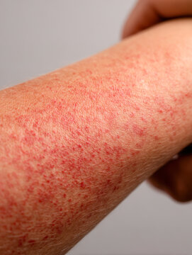 Detailed view of irritated human skin with a widespread red rash on the forearm showing symptoms of allergic reaction or skin inflammation on fair complexion