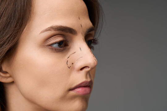 Rhinoplasty preoperative surgical mapping on female nose and bridge. Close up of young woman face with dashed ink lines for nose reshaping and septoplasty planning in plastic surgery clinic