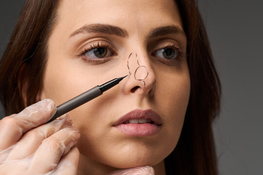 Rhinoplasty plastic surgery clinic preoperative surgical mapping young woman face dashed ink lines female nose bridge nose reshaping septoplasty planning
