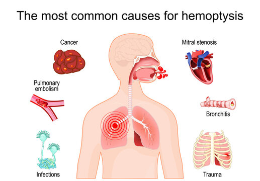 Hemoptysis causes. coughing up blood. Blood in sputum, Pulmonary bleeding.