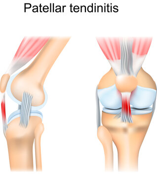 Patellar tendinitis. Patellar tendon inflammation.