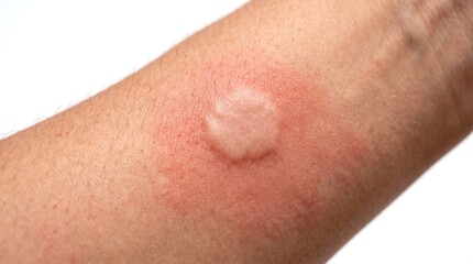 Fototapeta premium Raised skin wheal with red surrounding erythema on human arm showing allergic reaction