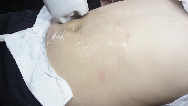 Non-invasive radio frequency body contouring treatment on the abdomen of a male client. Using an RF applicator for skin tightening and body sculpting in an aesthetic clinic.