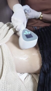 Female patient receiving radiofrequency back contouring treatment at an aesthetic clinic for skin tightening and fat reduction