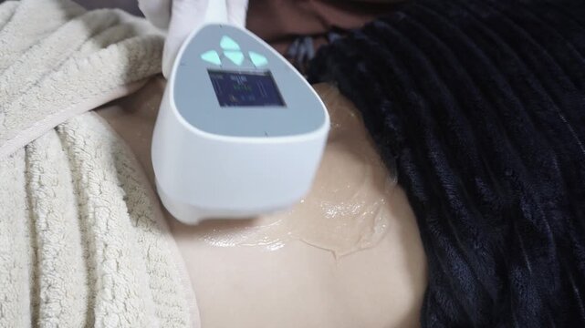 Female patient receiving radiofrequency back contouring treatment at an aesthetic clinic for skin tightening and fat reduction