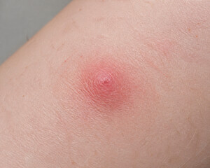 Fototapeta premium Red swollen mosquito bite on forearm skin, insect bite irritation and allergy