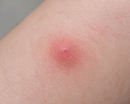 Red swollen mosquito bite on forearm skin, insect bite irritation and allergy