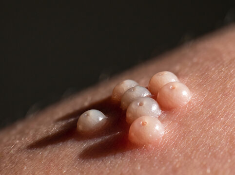 Molluscum Contagiosum Dome Shaped Pearly Papules with Central Dimple on Adult Skin, Viral Skin Infection Extreme Macro Photograph