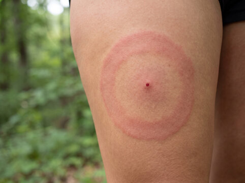 Erythema Migrans Expanding Bulls Eye Rash of Lyme Disease on Adult Thigh, Tick Borne Skin Infection Medical Stock Photograph