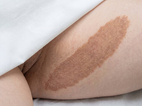 Erythrasma Brown Wrinkled Patch in Adult Groin Fold from Corynebacterium, Superficial Bacterial Skin Infection Medical Photograph
