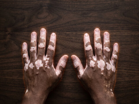 Vitiligo Sharply Bordered Depigmented White Patches on Adult Hands, Autoimmune Pigment Loss Skin Disease Medical Photograph