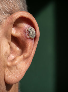 Squamous Cell Carcinoma Firm Crusted Keratotic Nodule on Older Adult Ear Rim, Skin Cancer Dermatology Reference Photograph