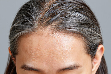 Fototapeta premium Close up scalp and forehead with oily skin texture and gray hair strands
