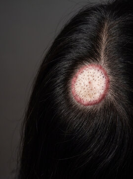 Discoid Lupus Erythematosus Scarring Plaque with Follicular Plugging on Adult Scalp Margin, Autoimmune Skin Disease Photograph