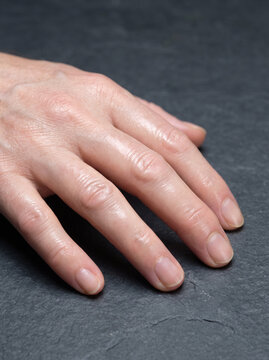 Scleroderma Sclerodactyly with Tight Shiny Skin and Curled Fingers on Adult Hand, Connective Tissue Disease Medical Photograph