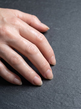 Scleroderma Sclerodactyly with Tight Shiny Skin and Curled Fingers on Adult Hand, Connective Tissue Disease Medical Photograph