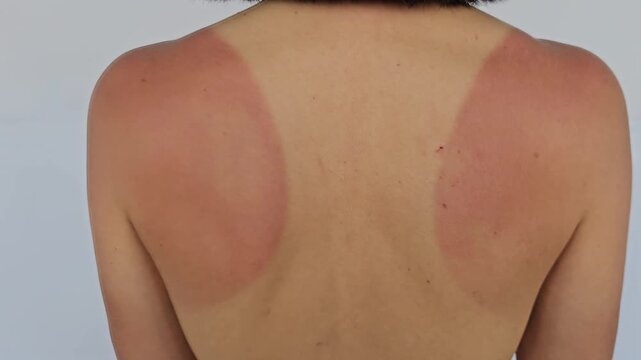 Sunburn patterns on back after a day at the beach in summer