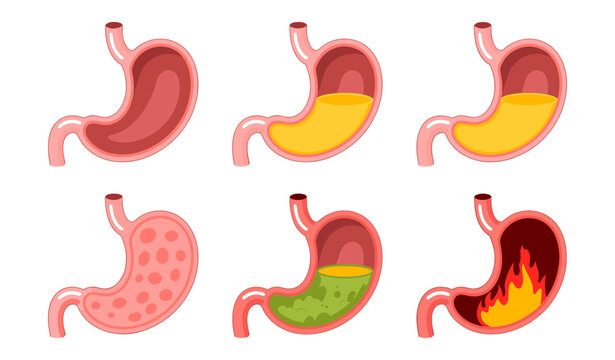 Human Stomach Anatomy and Gastric Health Vector Set Showing Heartburn Acid Reflux Inflammation Indigestion and Digestion Stages for Medical Infographic Designs