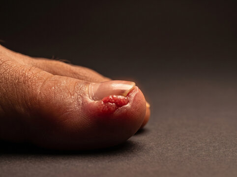 Ingrown Toenail with Inflamed Overgrown Nail Fold and Granulation Tissue on Adult Toe, Podiatry Medical Reference Image