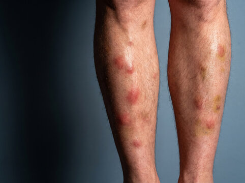Erythema Nodosum Tender Deep Red Nodules on Adult Shins, Panniculitis Inflammatory Skin Disease Medical Reference Image